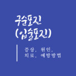 구순포진(입술포진) 증상, 원인, 치료, 예방방법